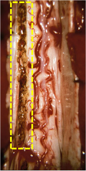 DREZ laesie intraoperatieve beeld (links)