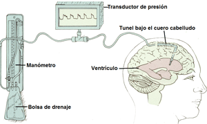 Medición de la presión del líquido cefalo-raquídeo mediante un drenaje ventricular externo 