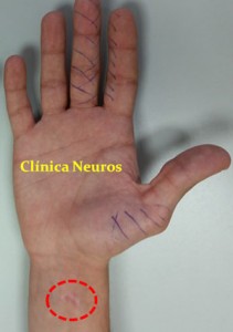 Lesion-nervio-mediano-en-muñeca
