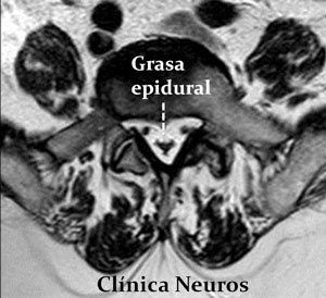 Lipomatosis-epidurral-lumbar-axial