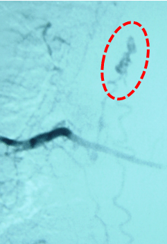 Imagen angiográfica de malformación arteriovenosa medular de tipo dural 