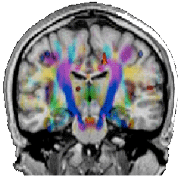 Afbeelding van 3-Tesla MRI in coronale deel van de zenuwbanen
