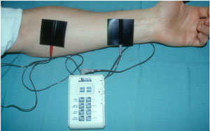 Transcutane elektrische stimulatie of TENS