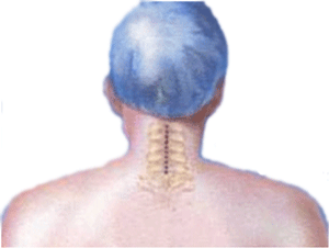 Posterior cervical approach 