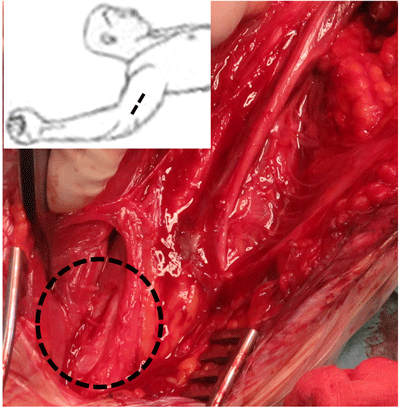 Anastomosis of a median nerve motor fascicle to the motor branch of the brachialis anterior muscle (Oberlin Technique II)