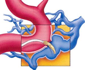 Användning av en ballong för att  blockera en intrakavernös aneurysm