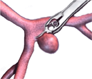 Surgical treatment of a cerebral aneurysm with clipping 