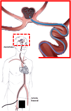Intravascular access to the aneurysm