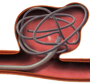 Början av aneurysmfyllning med coils