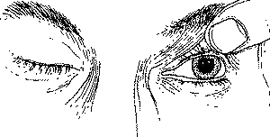 Dilatation der Pupille im Fall eines Aneurysma