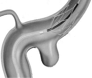 Uso de un stent para evitar las salida de los coils de interior de un aneurisma 