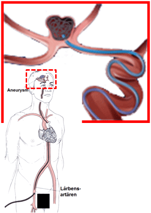 Intravaskulärt tillträde till aneurysmen