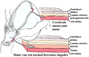 Wand van een cerebrale aneurysma