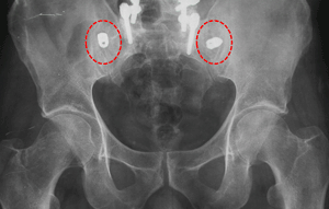 Artrodesis bilateral de la articulación sacro-ilíaca mediante cilindros de titanio 