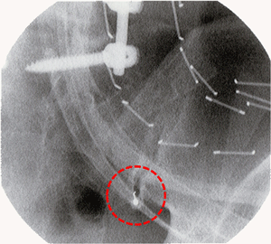 Infiltration of the sacro-iliac joint 