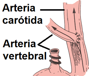 Re-implantación de la arteria vertebral en la arteria carótida primitiva 