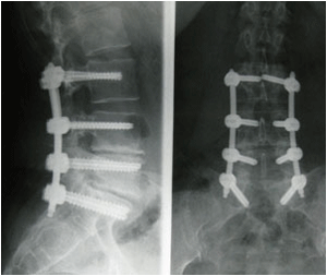 X-ray image after lumbar postero-lateral arthrodesis, which may be achieved with open-field surgery (left) or percutaneously (right)
