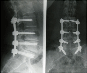 Artrodesis Lumbar Postero lateral Percut nea Cl nica Neuros 