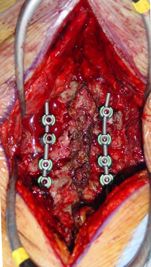 Imagen intraoperatoria de artrodesis cervical posterior en fractura de C4 y C5 