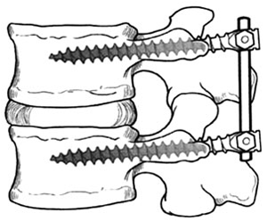 Lateral view in lumbar postero-lateral arthrodesis