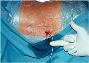 Intrathecale katheter plaatsing voor intrathecale toediening van baclofen