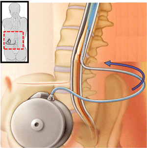 Implantable infusion's pump for a continuos intrathecal admnistration of Baclofen