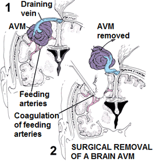 Surgical removal of a brain AVM