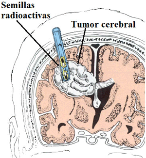 Braquiterapia con semillas radioactivas en el tratamiento de un glioma cerebral 