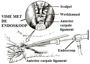 Endoscopische benadering van de decompressie van het carpale tunnel syndroom