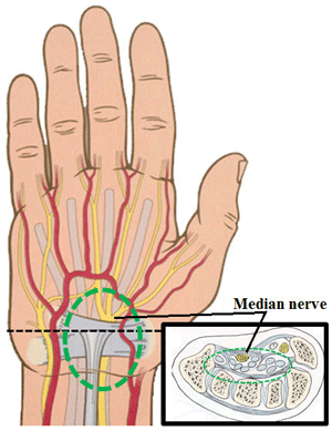 Median nerve as it passes through the carpal tunnel
