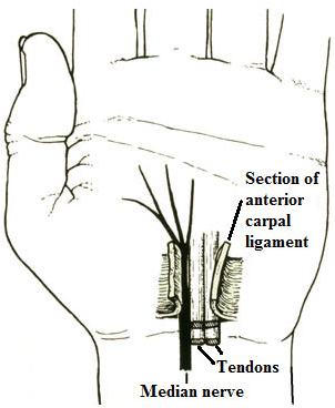 Section of the anterior carpal ligament to release the median nerve 