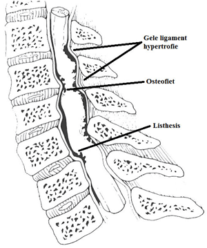 Cervicale spondylosis met cervicale stenose