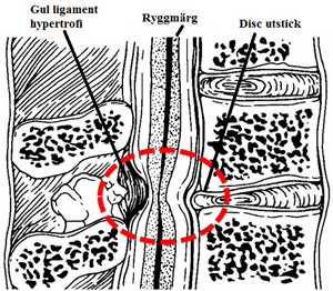 Cervical kanal stenos 