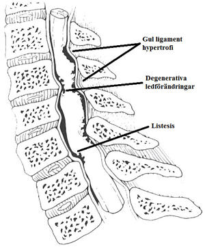 Cervikal spondylos med cervikal stenos