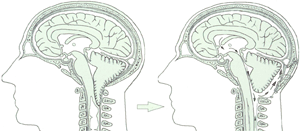 Links Chiari I Malformation mit Syringomyelie, rechts Dekompression Scharnier cranio-zervikalen