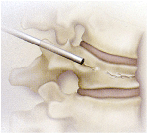 Collapsed bone tissue puncture during balloon kyphoplasty