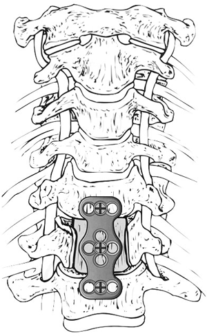Frontansicht des zervikalen Korpektomie mit Knochentransplantat und Plattenosteosynthese in Spinalkanalstenose am zervikalen Ebene