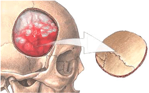 Craniotomy for the removal of a brain AVM