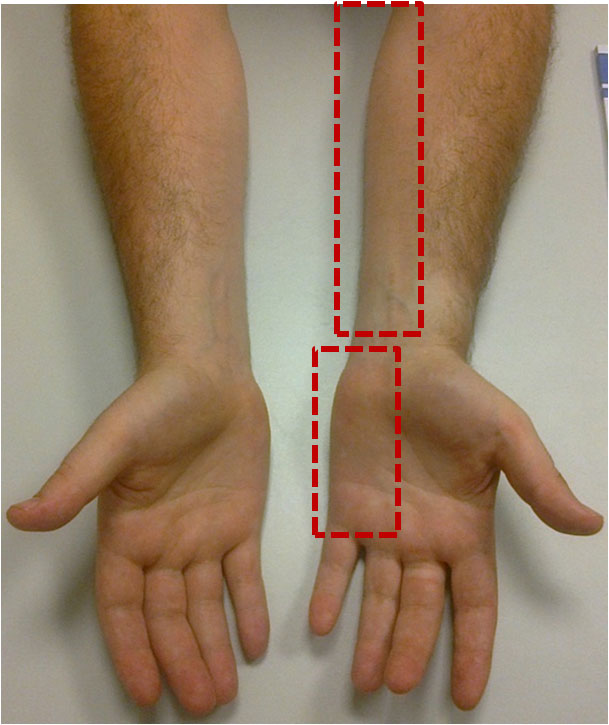 Atrofi av förarmen och hypotenarmusklerna vid inklämning av ulnarisnerven vid armbågen