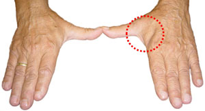 Atrofie van de duimmuis spieren in entrapment syndroom van de nervus ulnaris