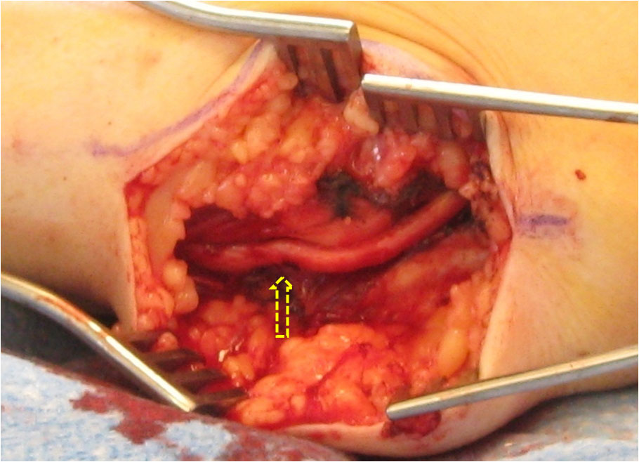 Ulnar nerve exposed distal to the elbow in open field surgical approach 