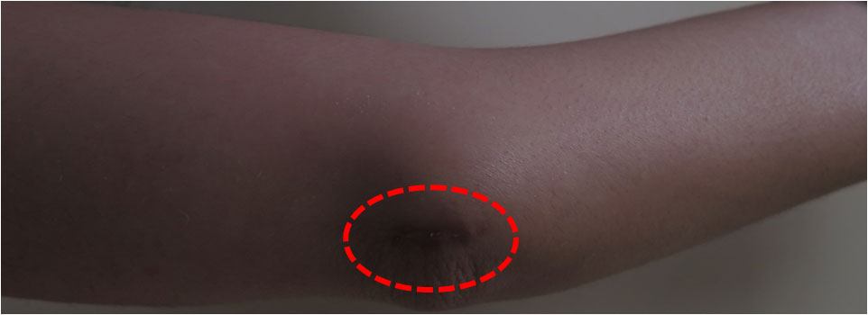 Cicatriz al mes de la intervención de descompresion del nervio cubital en el codo 