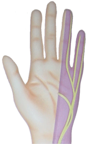 Symtom på ulnarisnervinklämning: stickande känsla och domning på handens ulnarissida och 4de och 5te fingrarna