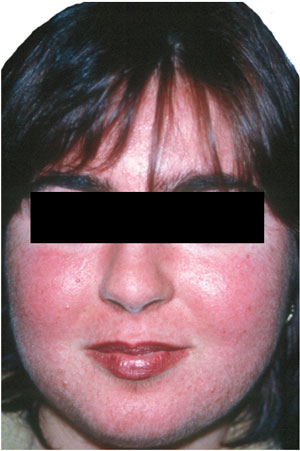 Sindrome De Cushing Cl nica Neuros Neurocirujano Valencia Sindrome De Cushing Cl nica Neuros Neurocirujano Valencia