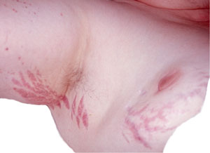 Striae due to Cushing’s syndrome