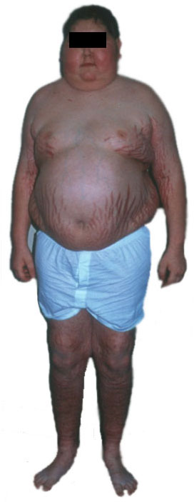 Cushing’s syndrome as seen up front