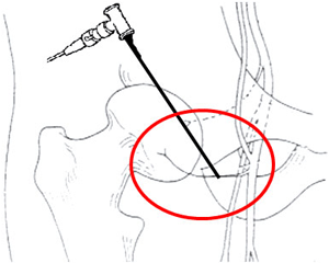 Percutaneous RF hip denervation sketch