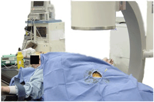 Intra-operative picture of percutaneous RF hip denervation