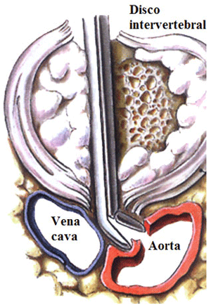 Lesión de los grandes vasos abdominales en el curso de una discectomía lumbar 