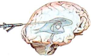 Intraventricular catheter placement in hydrocephalus 